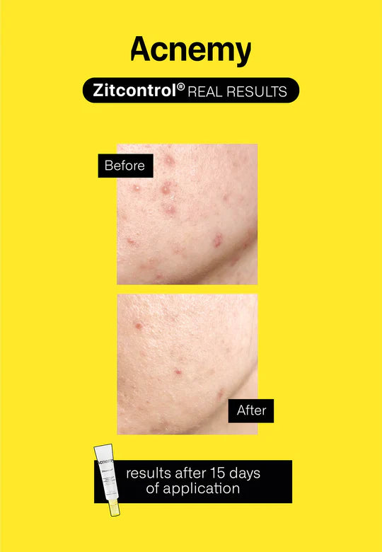 Acnemy Zitcontrol