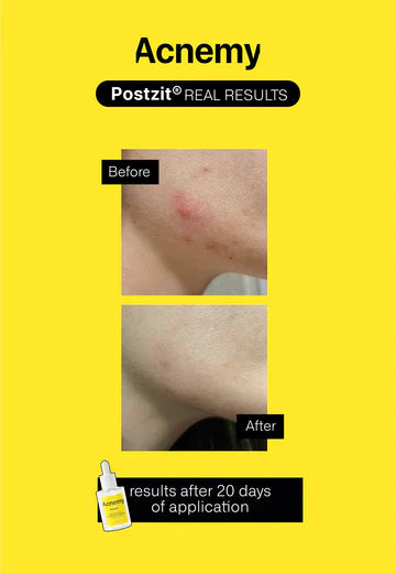 Acnemy Postzit