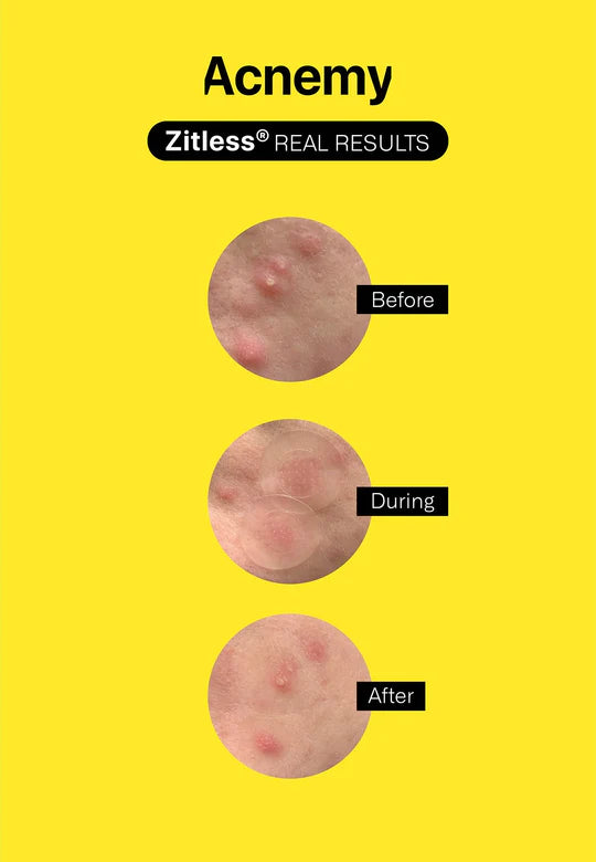 Acnemy Zitless 5 Pack