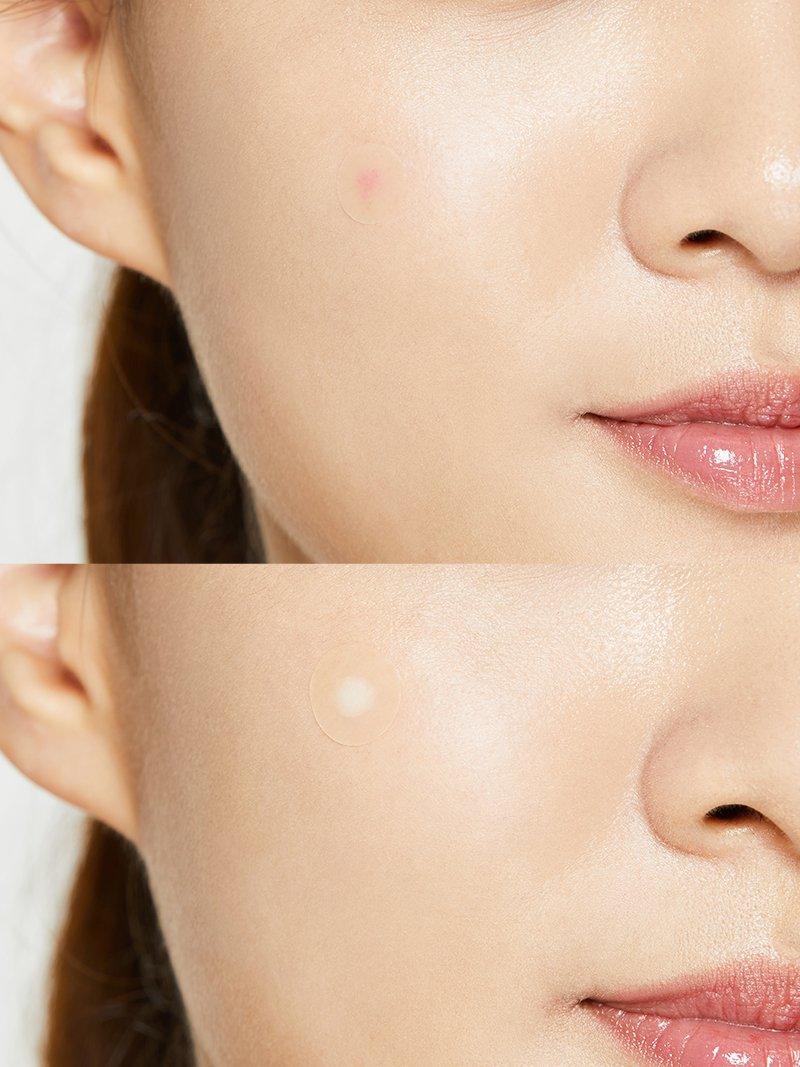 COSRX Acne Pimple Master
